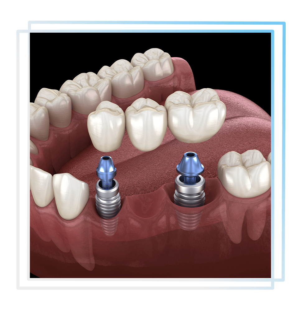 dental bridge 3d