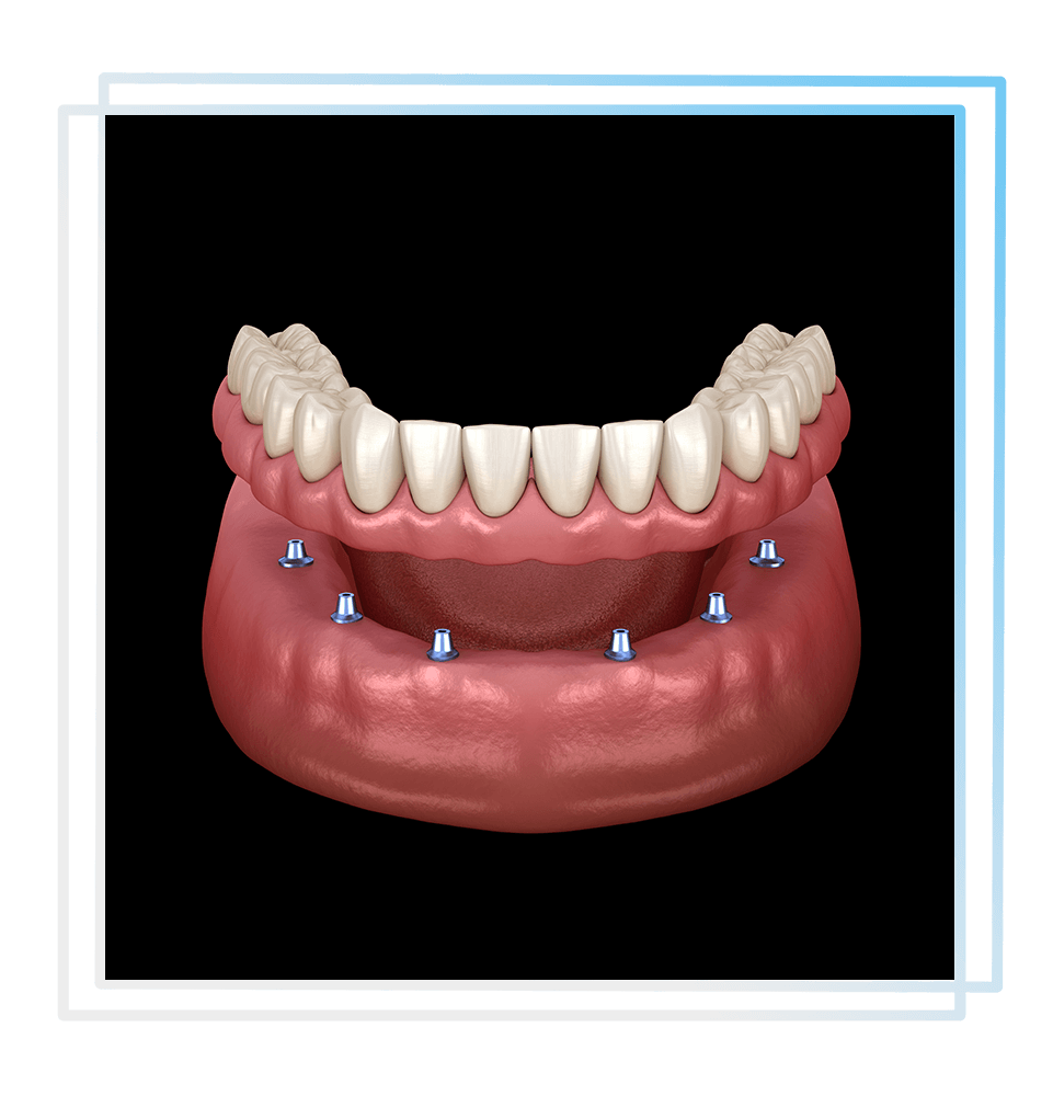 implant supported 3d