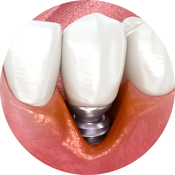 peri implantitis being shown 3d