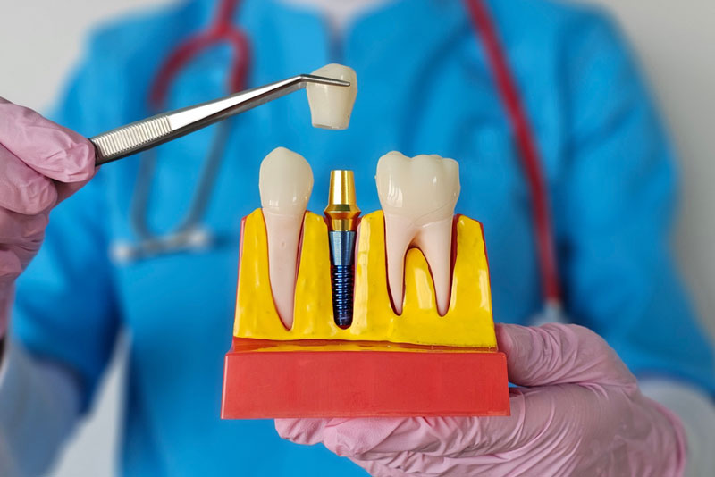 Dental model showing an implant with a crown being placed using tweezers.