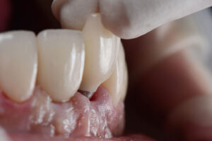 Close-up of a dental crown being placed onto an implant in a patient's mouth.