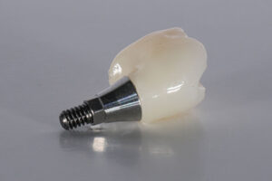 Close-up of a dental implant with a titanium post and ceramic crown, showcasing the components used in modern tooth replacement procedures.