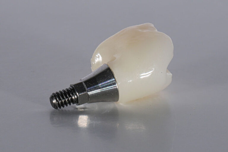 Close-up of a dental implant with a titanium post and ceramic crown, showcasing the components used in modern tooth replacement procedures.