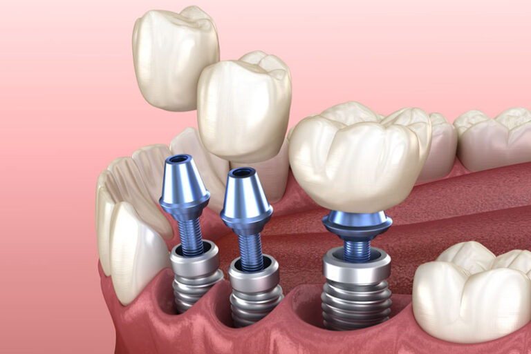 what are the 4 types of implants